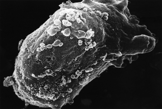 显微镜图像：一簇HIV病毒附着在一个淋巴细胞（lumphocyte）上。淋巴细胞是一种白血细胞（white blood cell）。